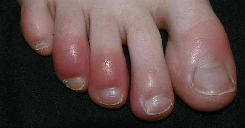 Chilblains
