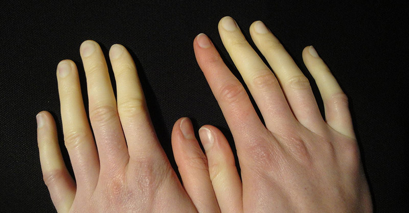 Raynauds